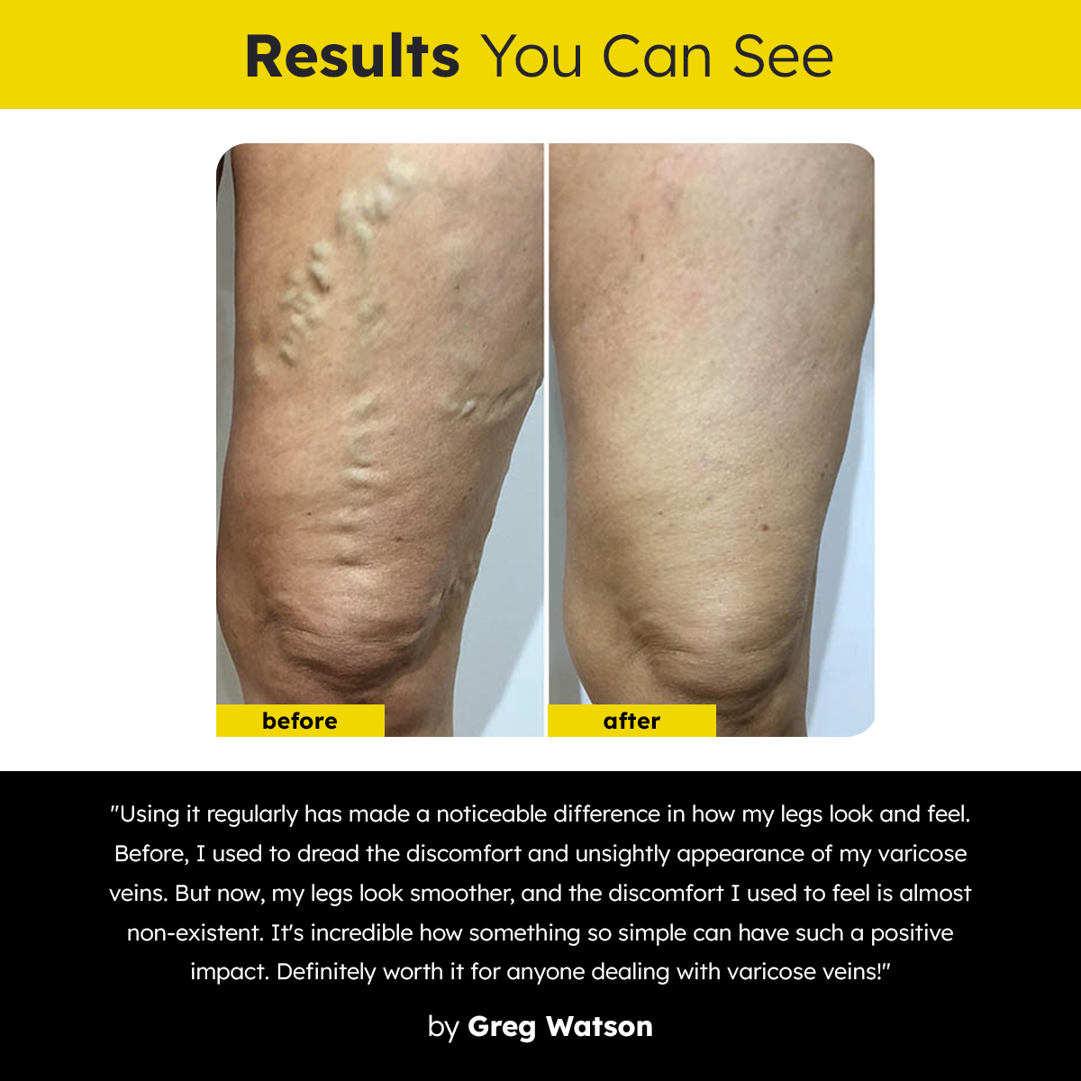 Dafeila™ VenoCare Varicose Veins EMS Device