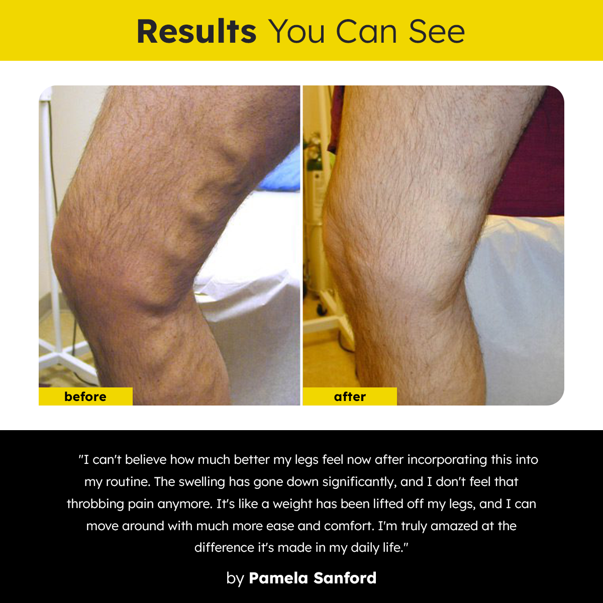 Dafeila™ VenoCare Varicose Veins EMS Device